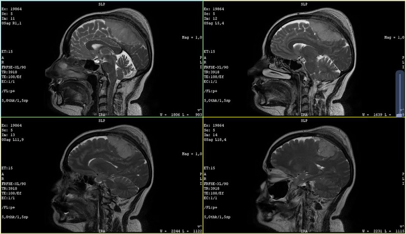 Meningioma on MRI at sagittal sinus