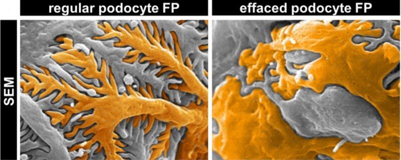 Foot process effacement on electron microscopy (MCD)