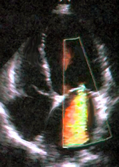 Echocardiogram showing mitral regurgitation