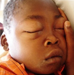 Periorbital edema in nephrotic syndrome