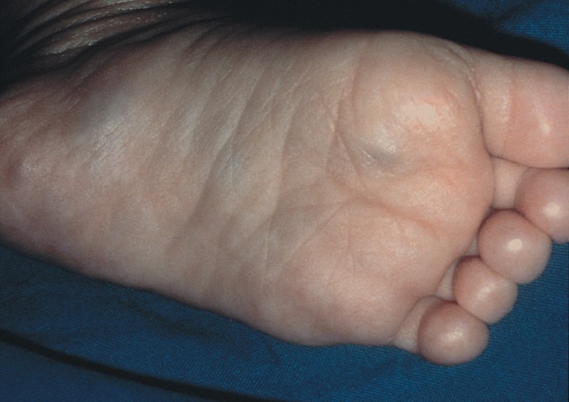 Blueberry muffin baby: Stage IV-S neuroblastoma with cutaneous metastases
