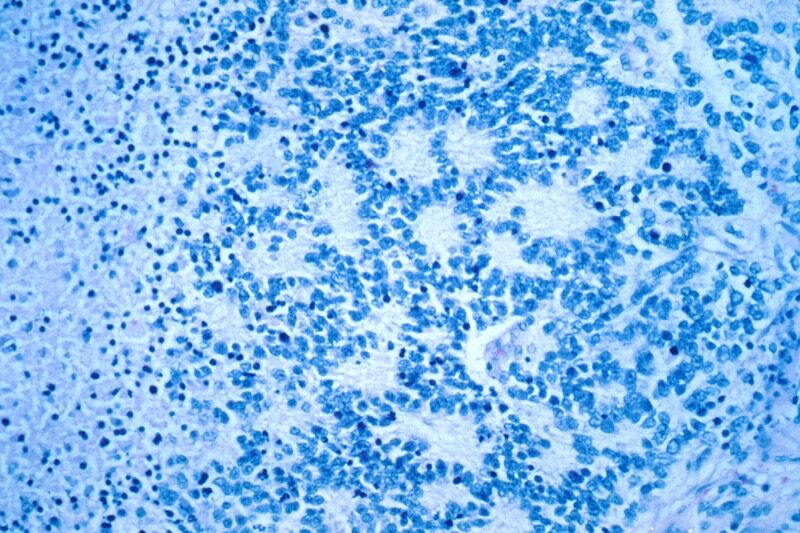 Homer-Wright rosettes neuroblastoma