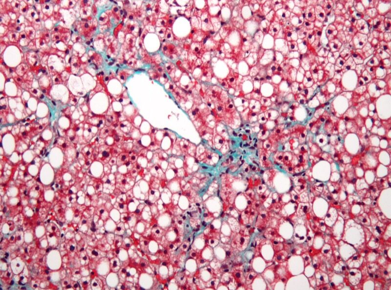 Non-alcoholic fatty liver disease histology