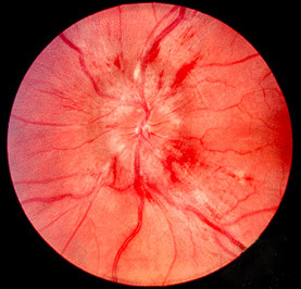 Fundus photograph of papilledema with swollen optic disc and blurred margins