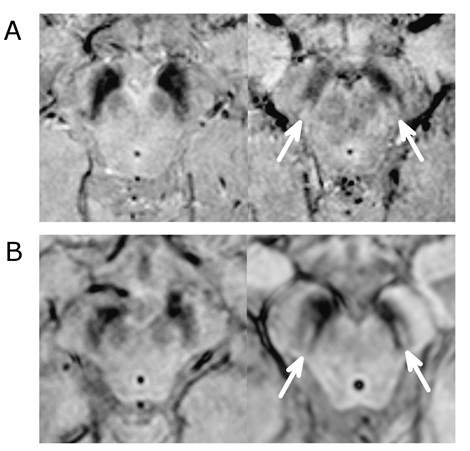 Parkinson disease posture comparison