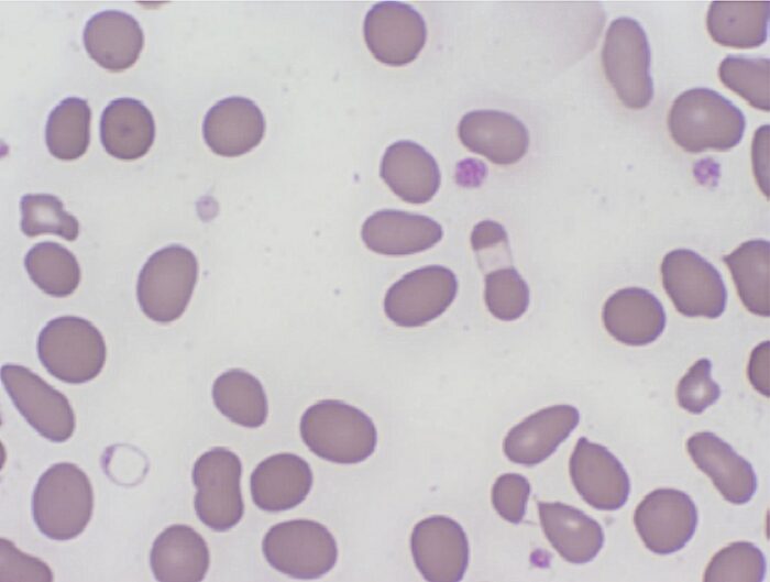 G6PD hemolytic crisis peripheral blood smear