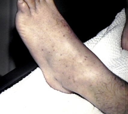 Pinpoint petechiae on skin