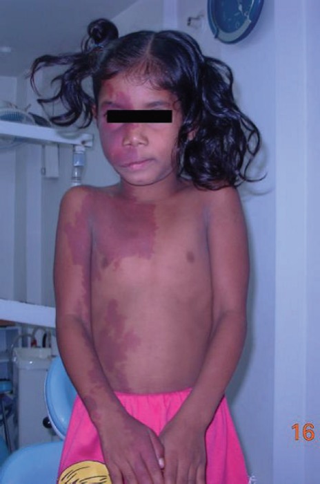 Port-wine stain in trigeminal V1 distribution of Sturge-Weber syndrome