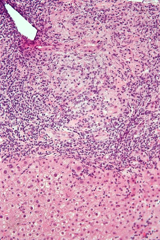 Primary biliary cholangitis histology