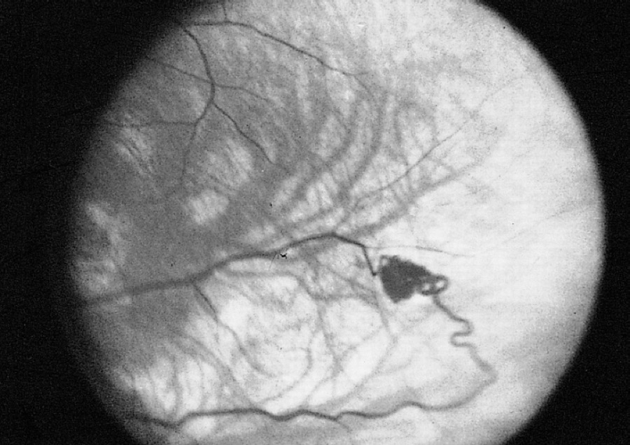 Retinal hemangioblastoma in Von Hippel-Lindau disease, fluorescein angiogram