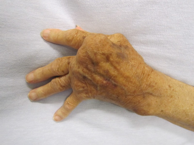 Rheumatoid arthritis hand deformities