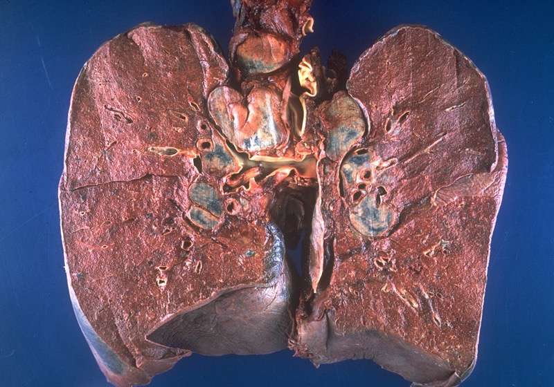 Sarcoidosis bilateral hilar lymphadenopathy on CXR