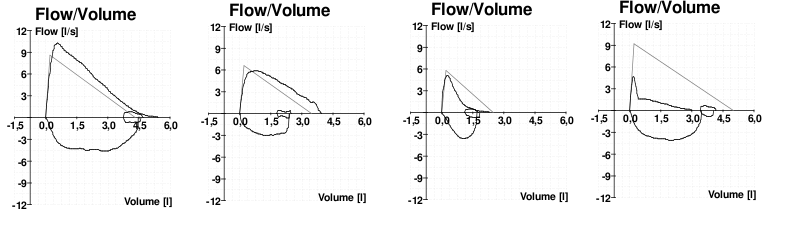 Spirometry flow-volume curves