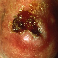 Squamous cell carcinoma on nose