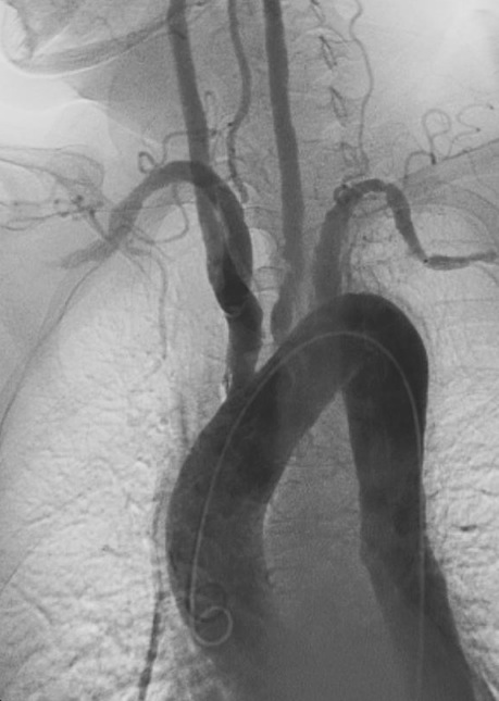 Angiogram showing stenosis of the aorta and major branches in Takayasu arteritis