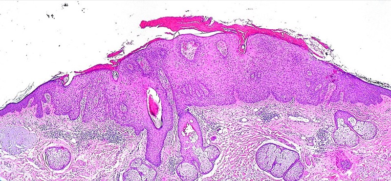 Actinic keratoses on forehead