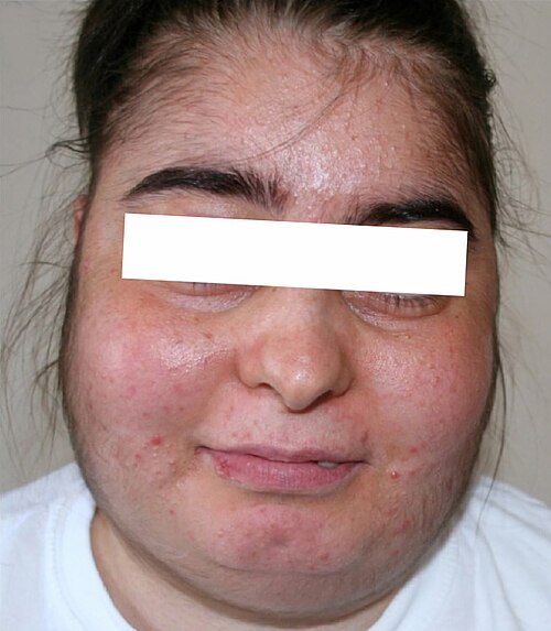 Cushing syndrome body habitus showing central obesity, moon face, and striae