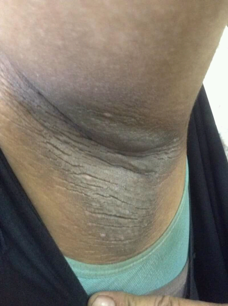 Acanthosis nigricans on the neck, a sign of insulin resistance
