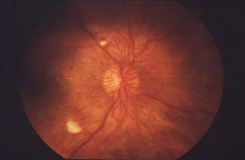 Fundus photograph of proliferative diabetic retinopathy