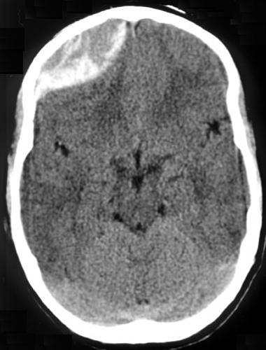 Axial CT of an acute epidural hematoma: biconvex lens of hyperdense blood between skull and dura