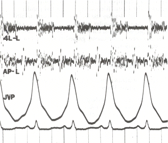 Phonocardiogram showing S1 and S2 heart sound components