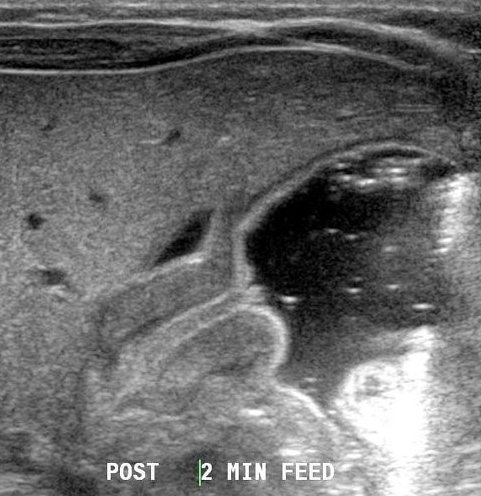 Ultrasound showing pyloric stenosis