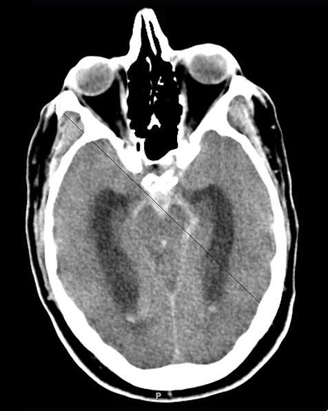 Axial CT of subarachnoid hemorrhage: hyperdense blood in the basal cisterns and sylvian fissures