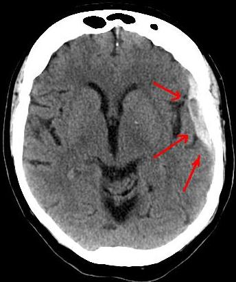 Axial CT of a subdural hematoma: crescent of hyperdense blood spanning the hemisphere