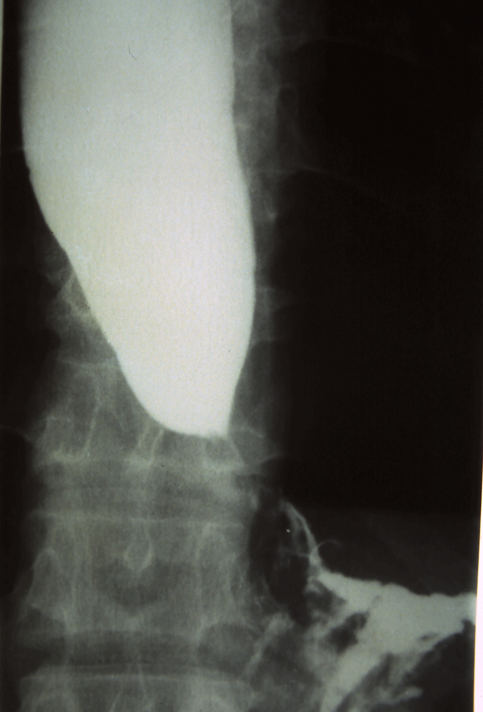 Dilated barium-filled esophagus tapering to a bird-beak at the lower esophageal sphincter