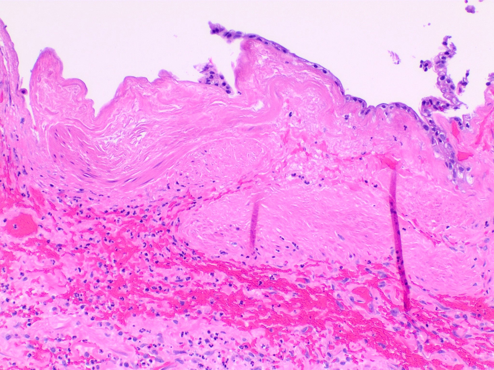Gallbladder mucosa with necrosis, dense neutrophils, and sloughing in acute gangrenous cholecystitis