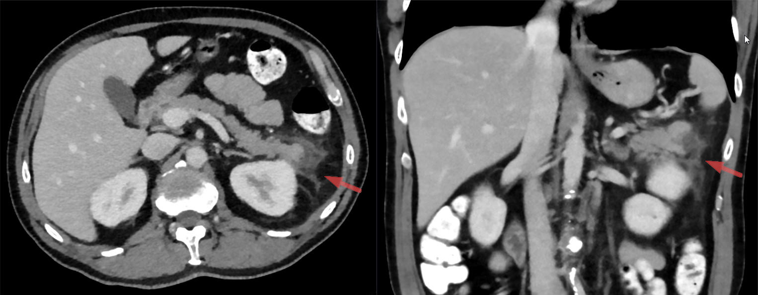 Axial and coronal CT showing inflammatory fluid tracking through fat around the pancreatic tail