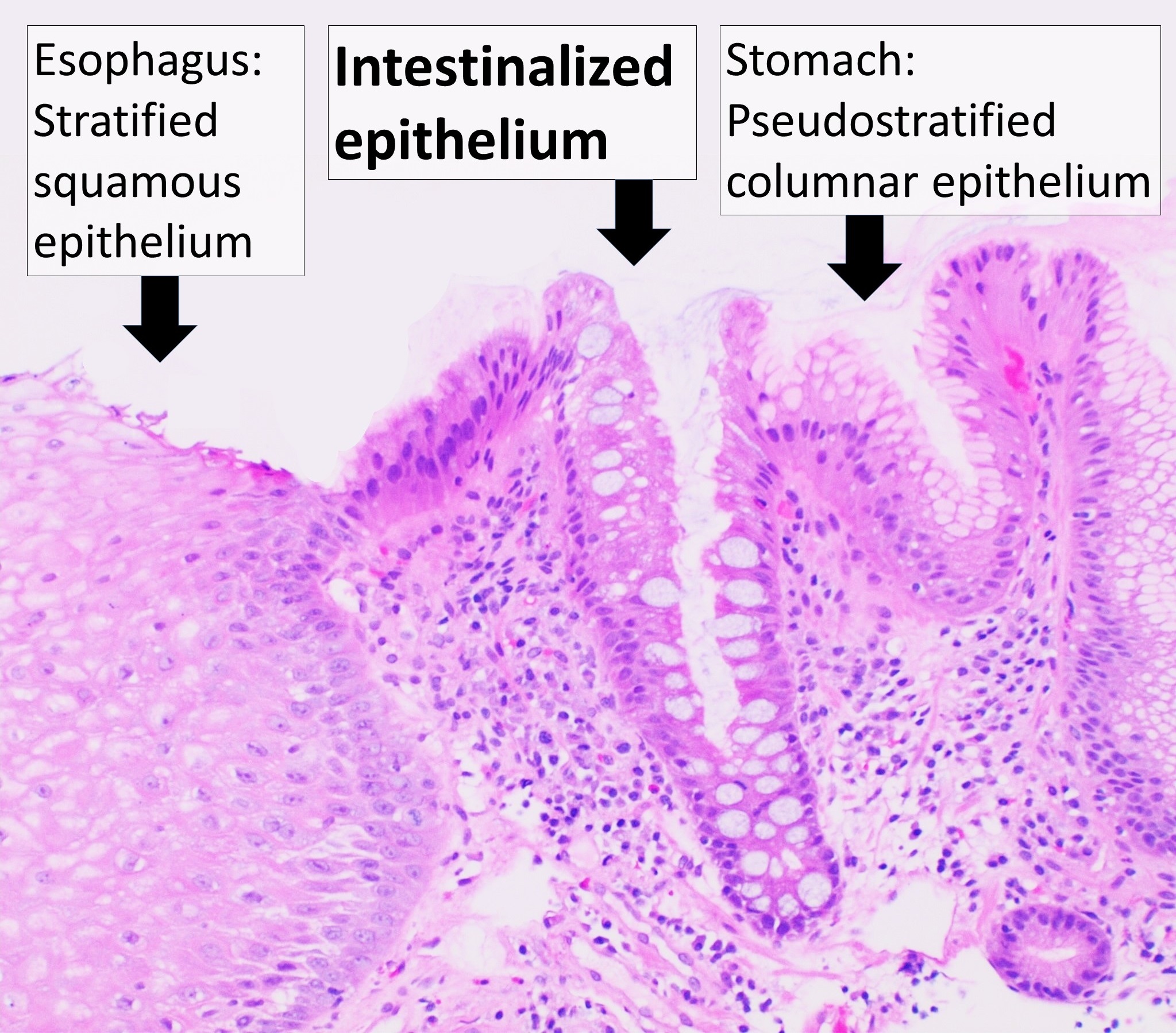 Barrett mucosa with goblet-cell intestinal metaplasia replacing normal stratified squamous epithelium