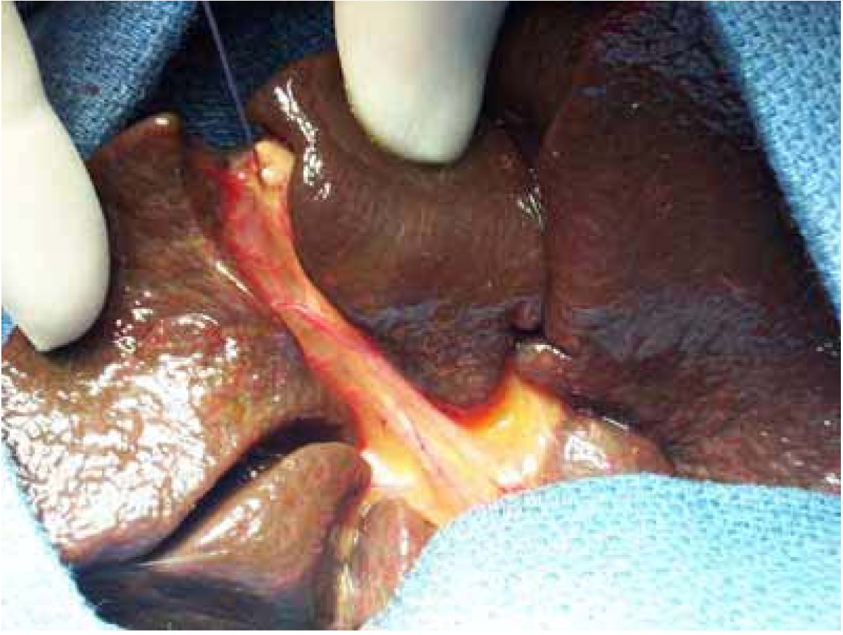 Operative view showing complete interruption of the extrahepatic biliary tree in biliary atresia