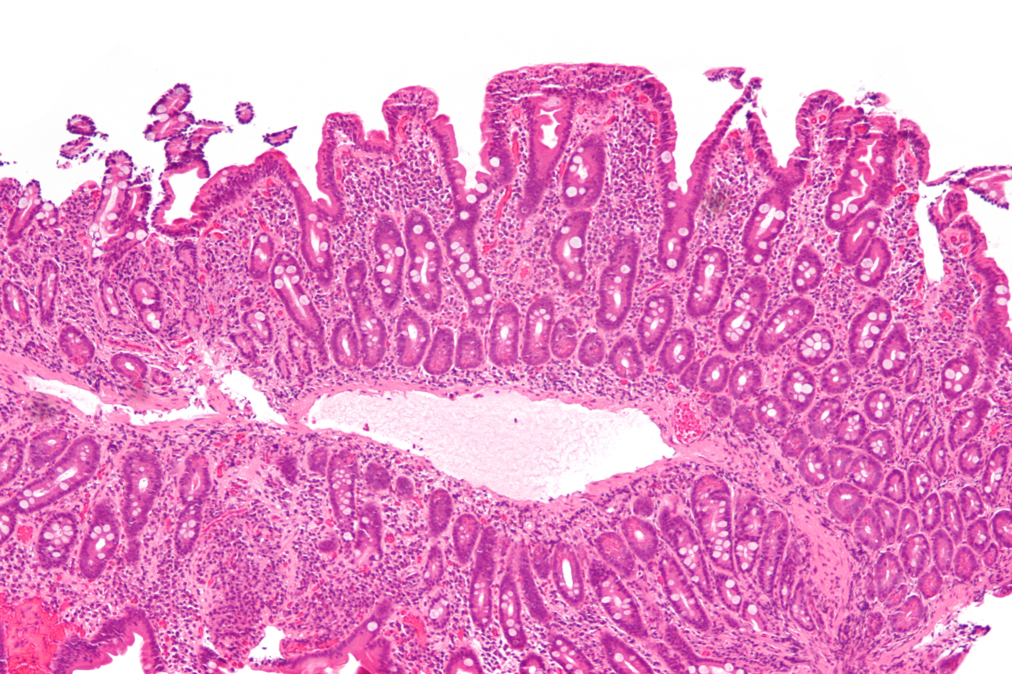 Small-bowel mucosa with blunted villi and expanded inflamed lamina propria in celiac disease