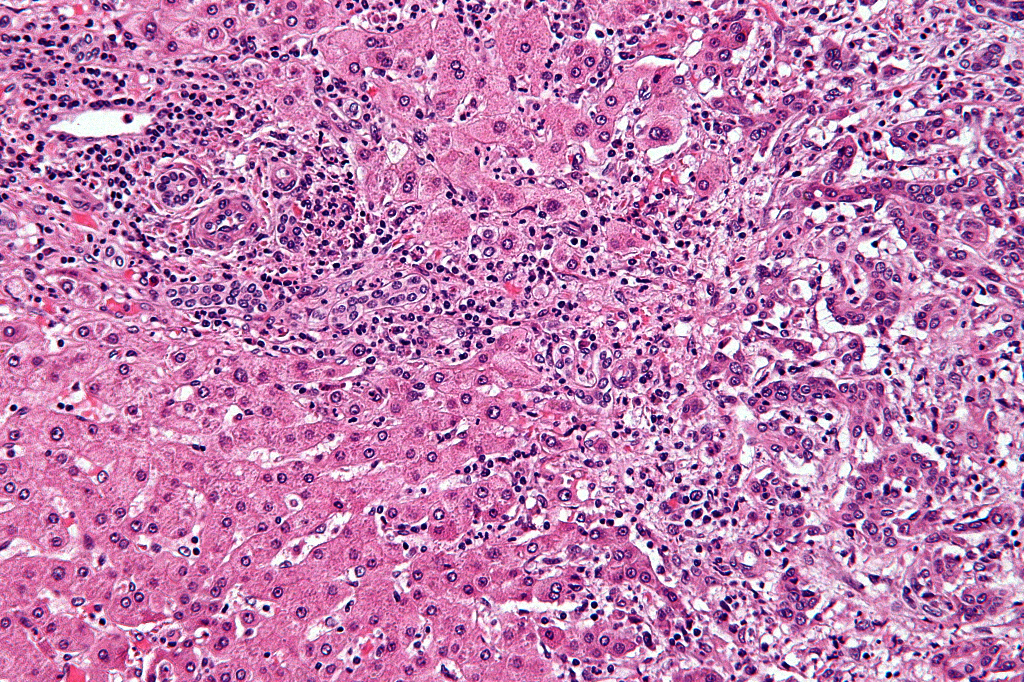 Atypical bile-duct-forming glands embedded in dense desmoplastic stroma in cholangiocarcinoma