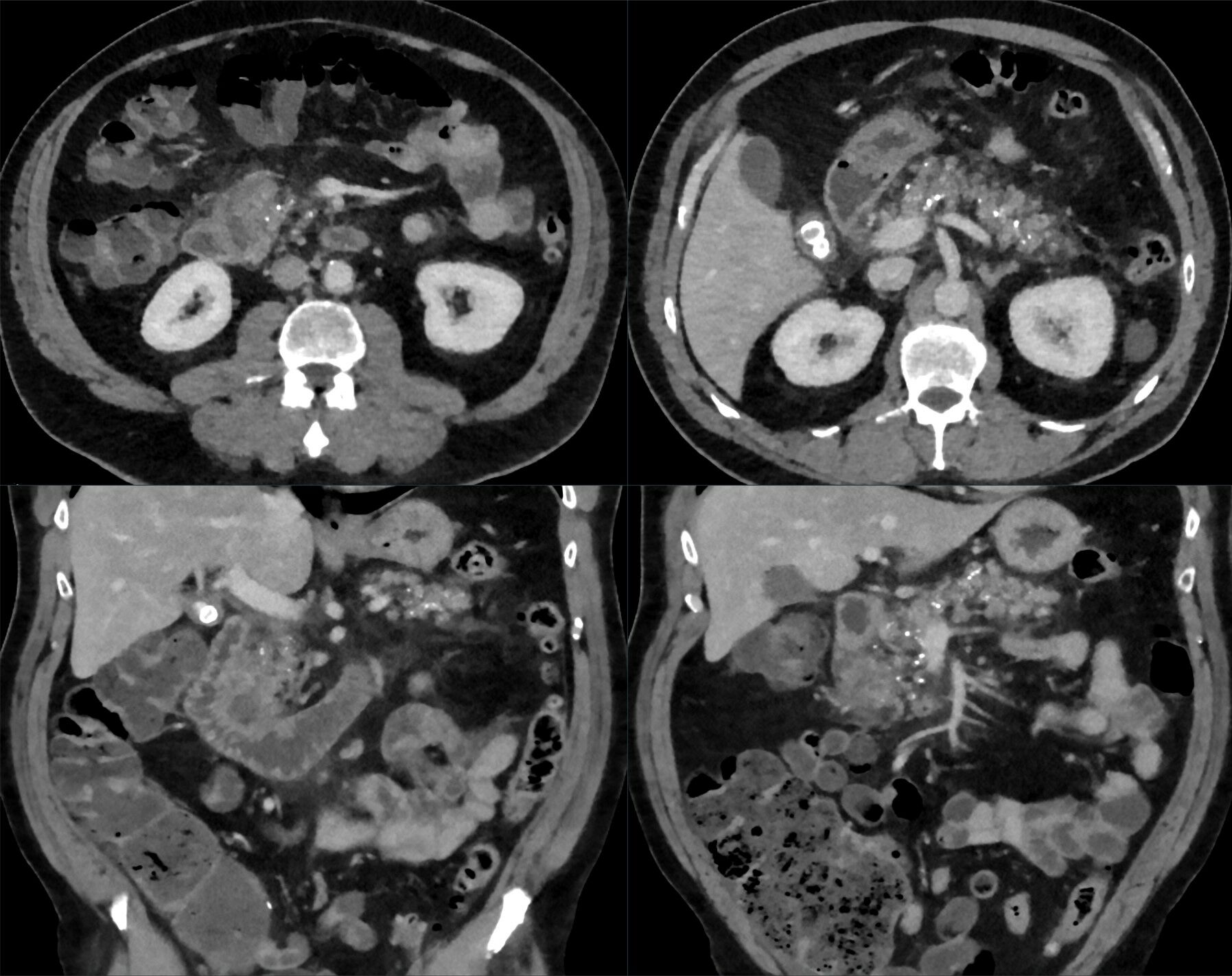 CT showing multiple pancreatic calcifications from chronic pancreatitis with superimposed groove inflammation