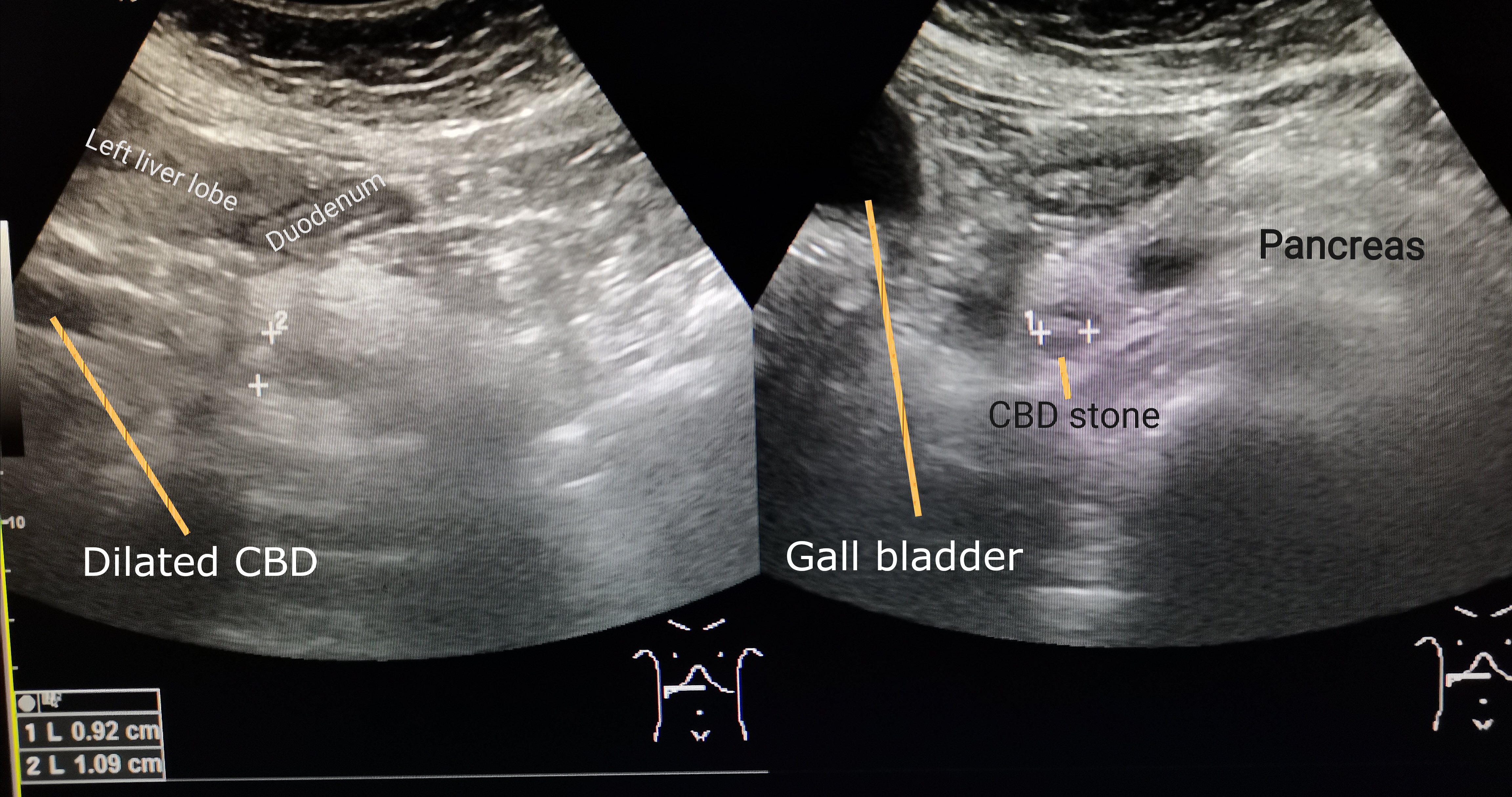 Distal common bile duct stone with upstream duct dilation on ultrasound
