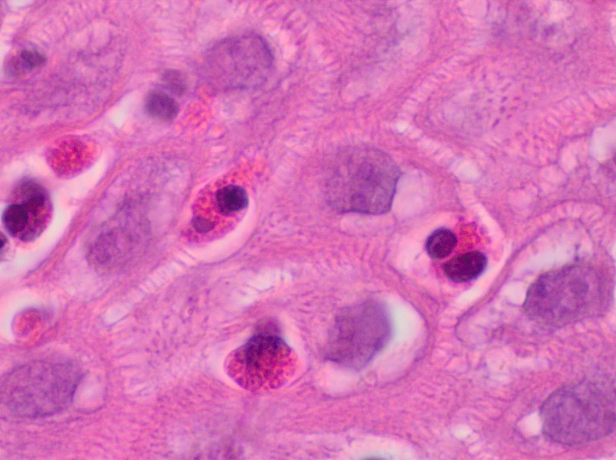 Esophageal epithelium packed with intraepithelial eosinophils and widened clear spaces from edema