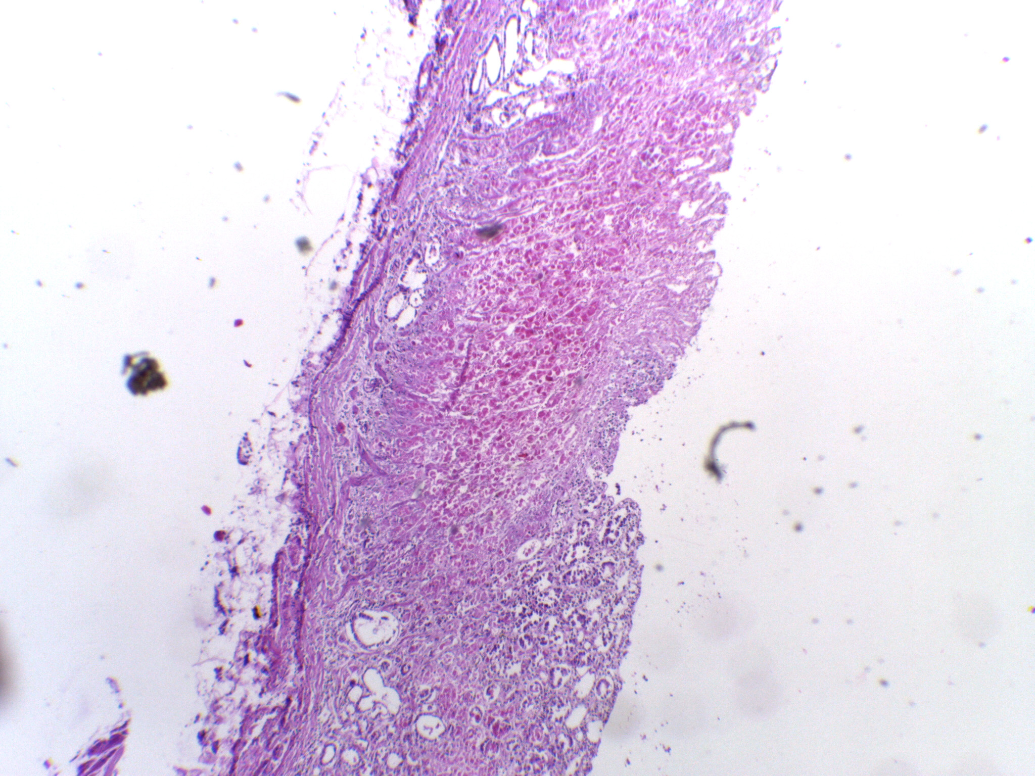 Gastric mucosa eroded into an acute stress ulcer with inflamed tissue at the ulcer edge