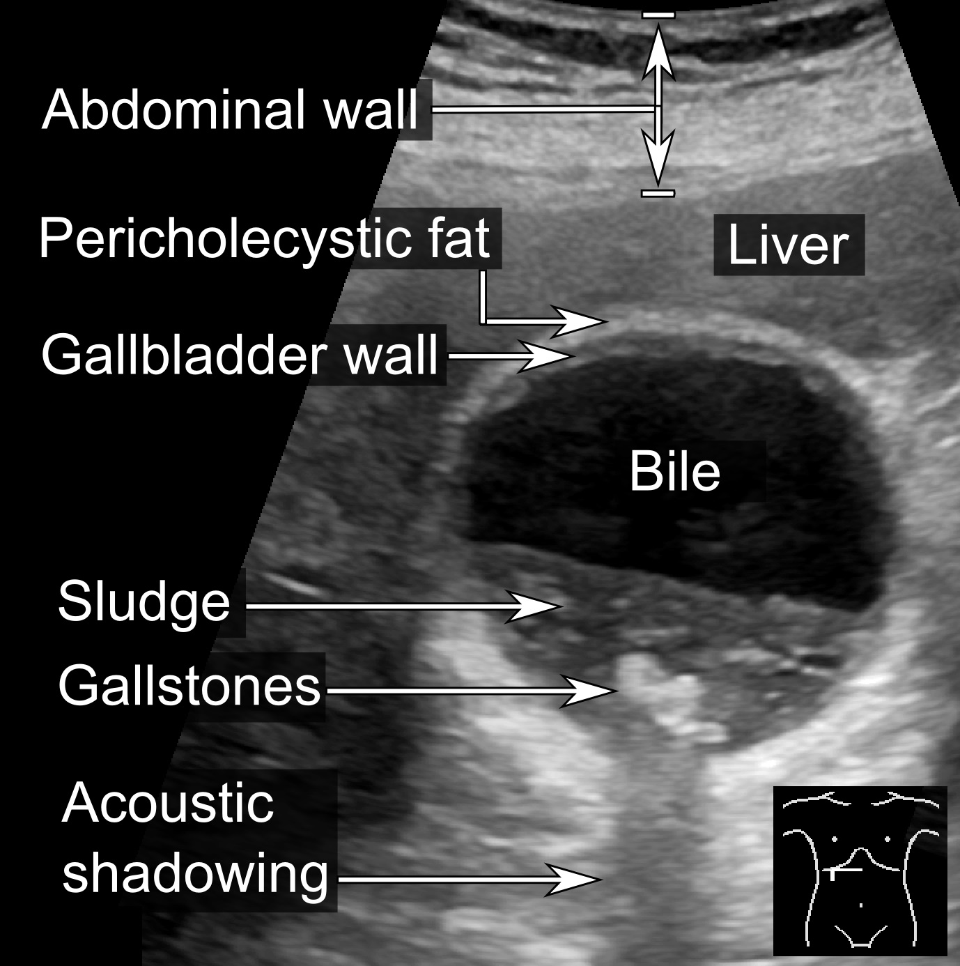 Gallbladder ultrasound with echogenic stones casting acoustic shadows above dependent biliary sludge