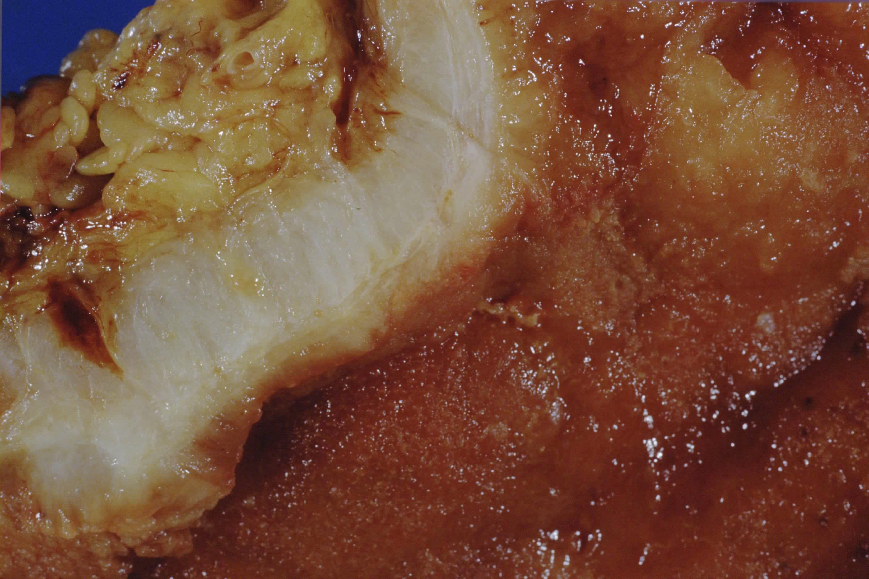Gross stomach wall diffusely thickened and rigid by infiltrative gastric carcinoma