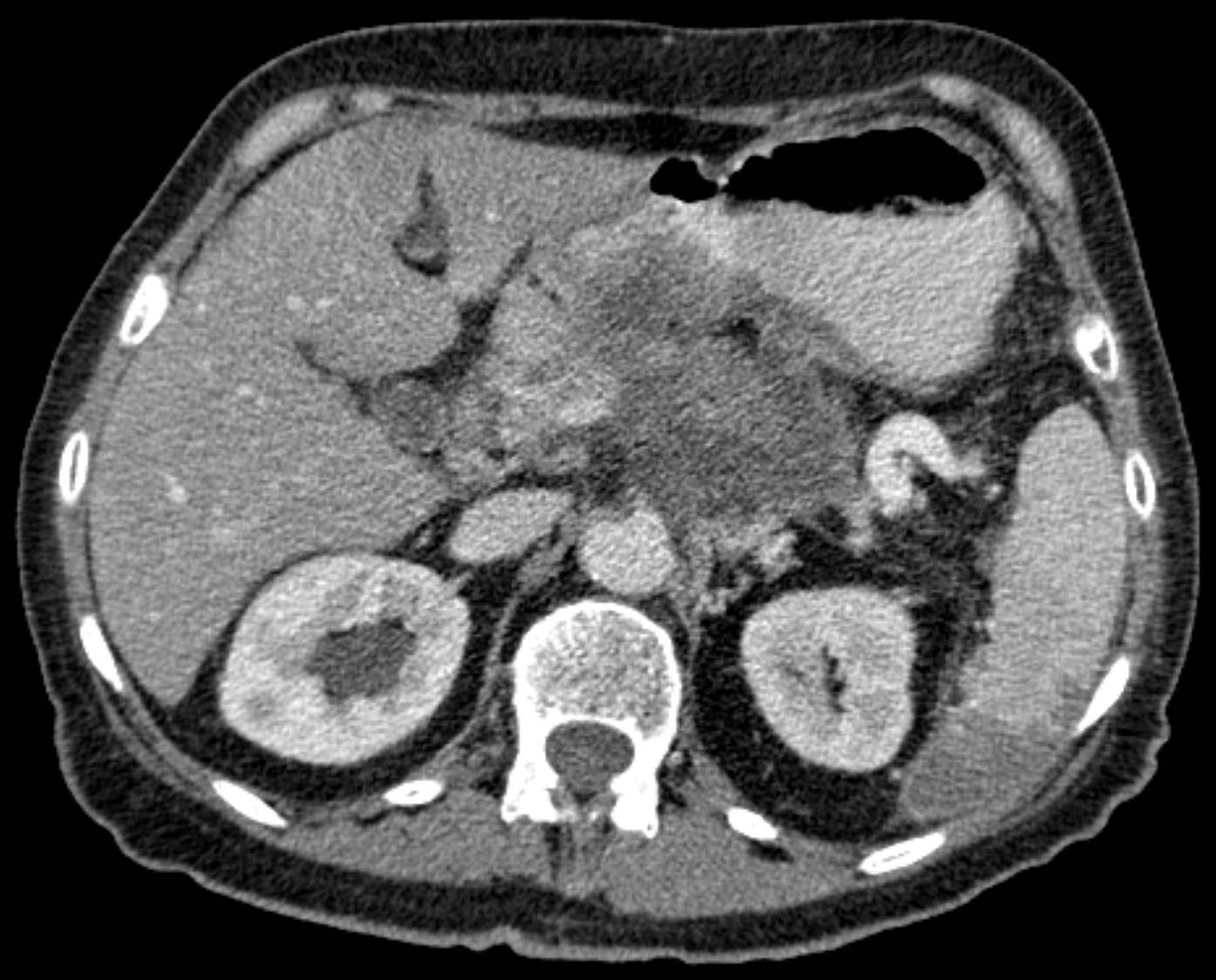 Contrast-enhanced axial CT showing an infiltrative pancreatic mass around the celiac region