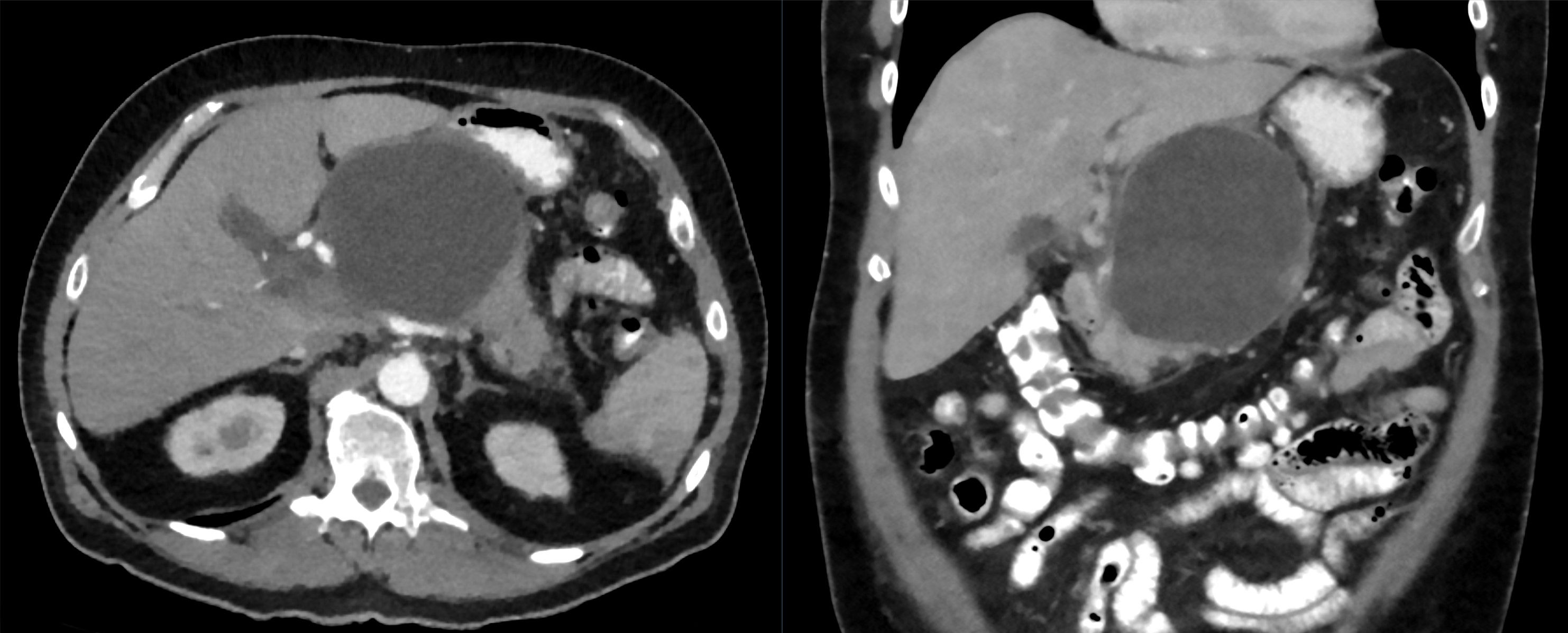 Large encapsulated pancreatic fluid collection abutting the stomach on CT
