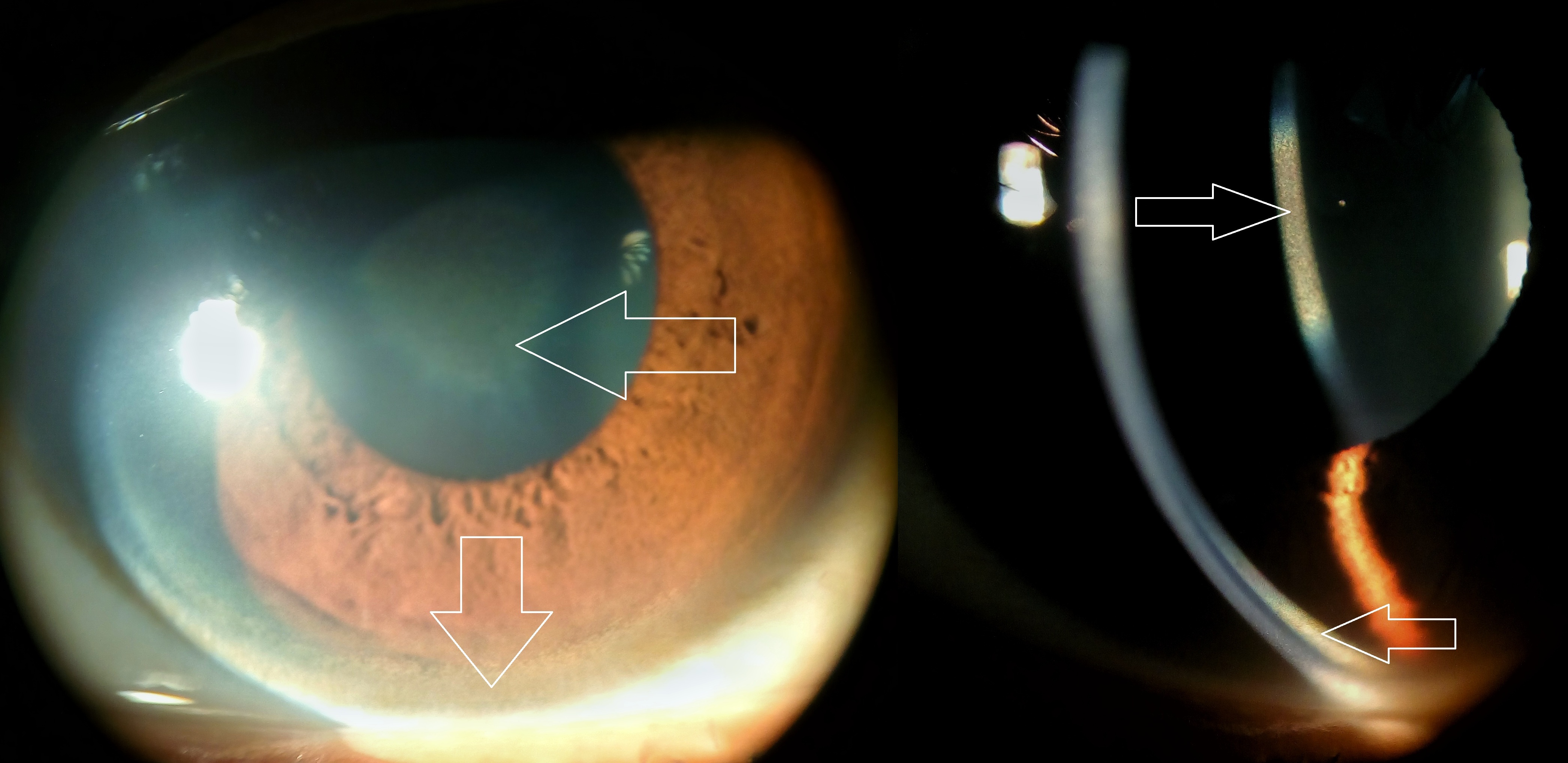 Golden-brown peripheral corneal Kayser-Fleischer ring from copper deposition in Wilson disease