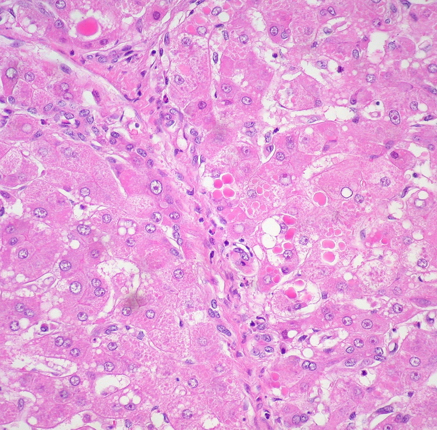 Liver biopsy with alpha-1 antitrypsin globules in hepatocytes