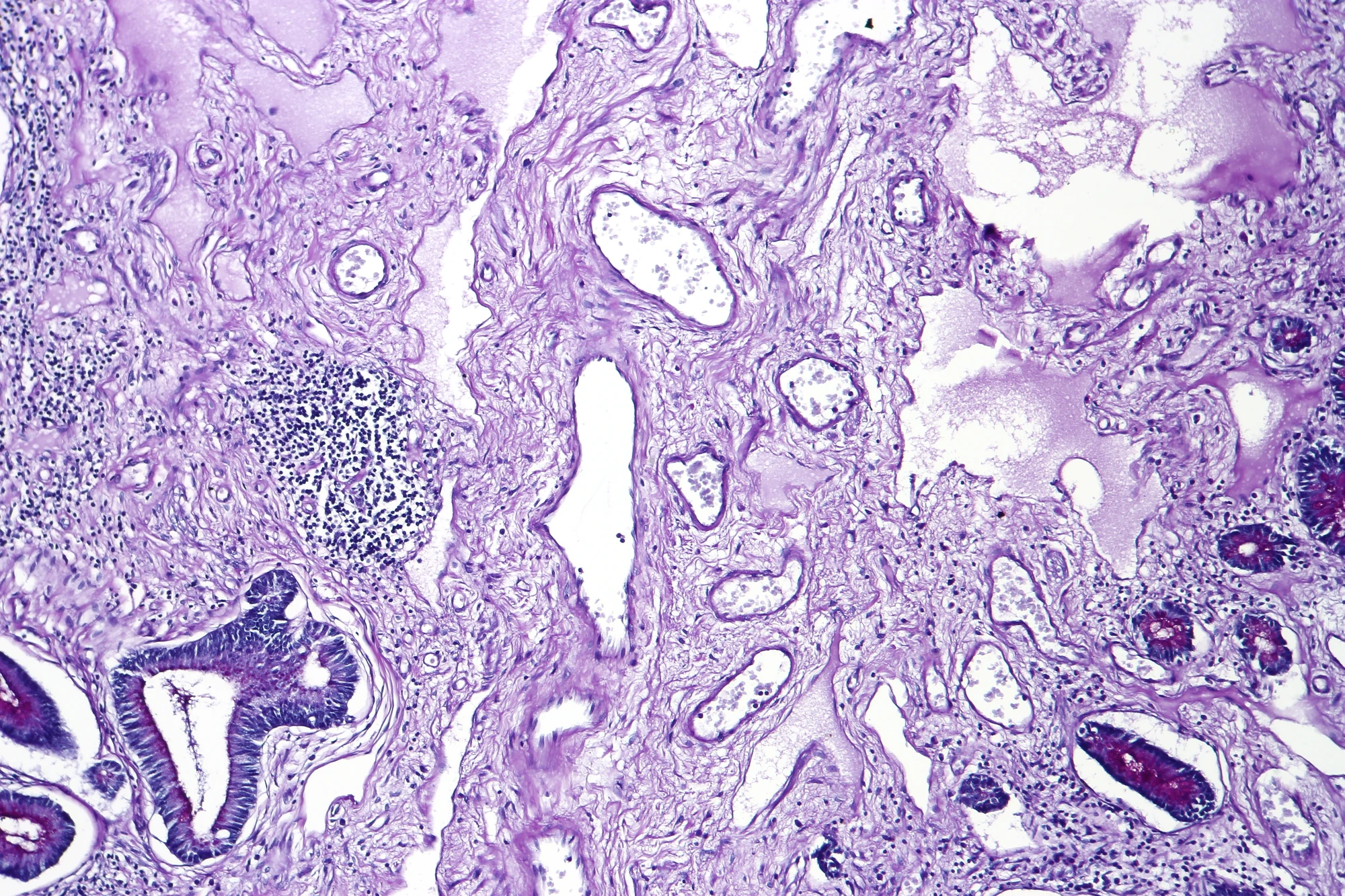 Colonic mucosa containing dilated thin-walled vessels of angiodysplasia