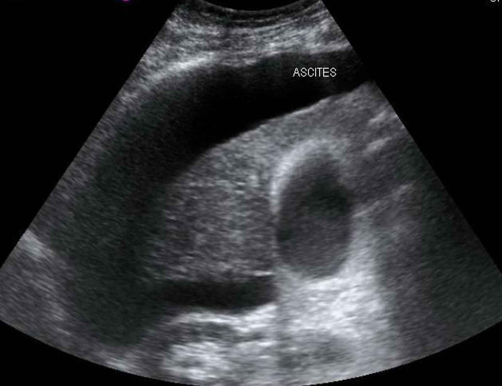 Ultrasound showing free intraperitoneal fluid consistent with ascites