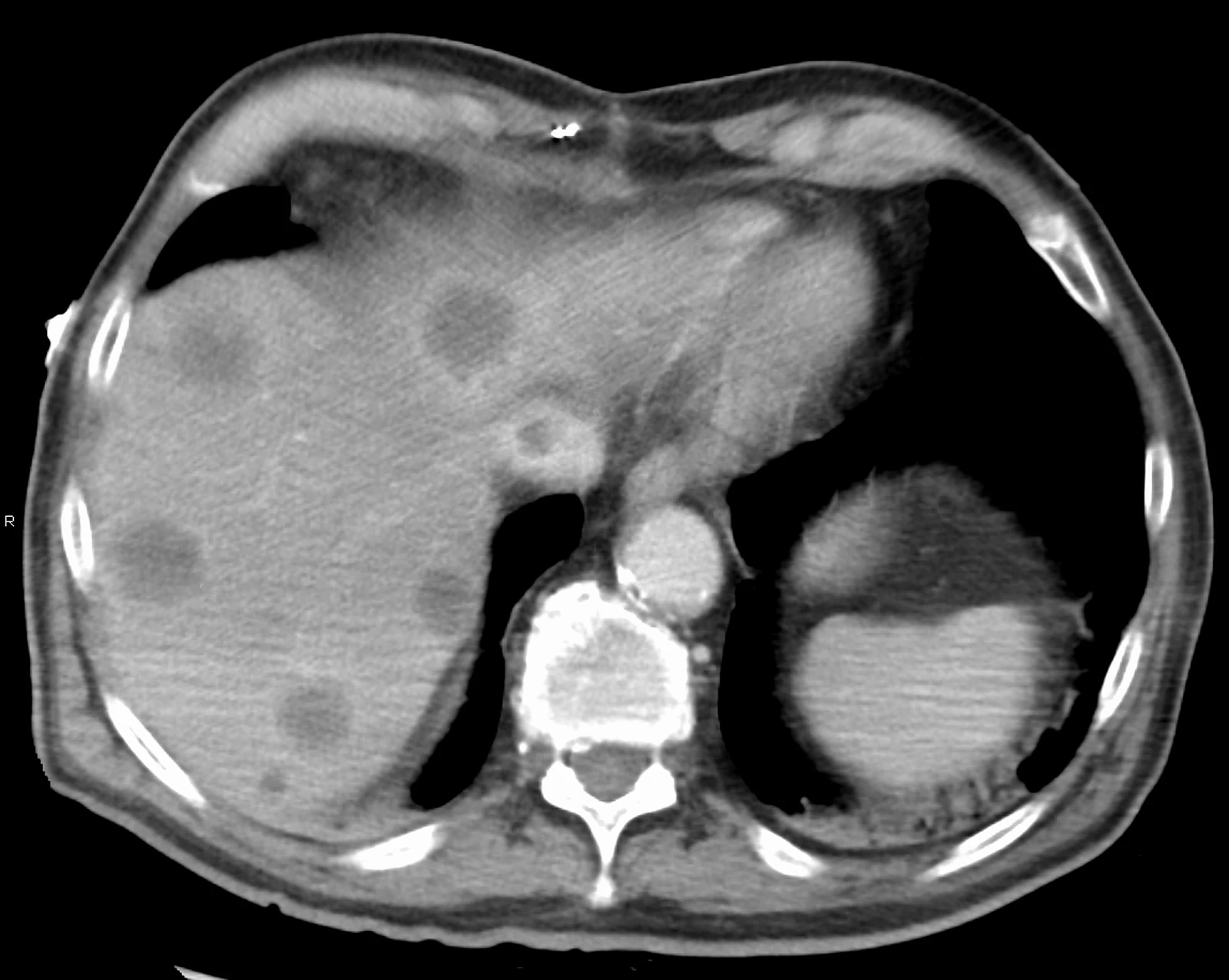 Cross-sectional imaging of hepatic venous outflow obstruction in Budd-Chiari syndrome