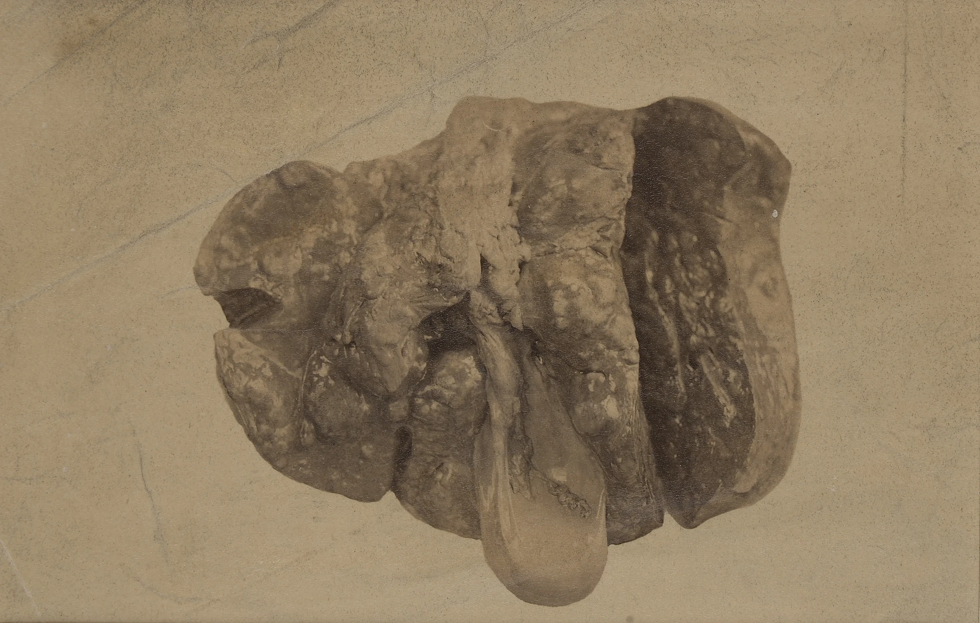 Gross nodular cirrhotic liver illustrating advanced chronic injury