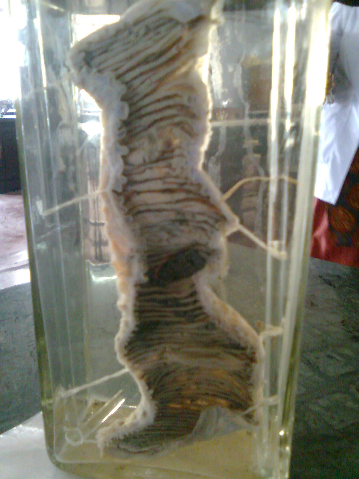 Resected colon containing an annular invasive carcinoma